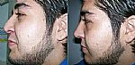 Antes y Despues